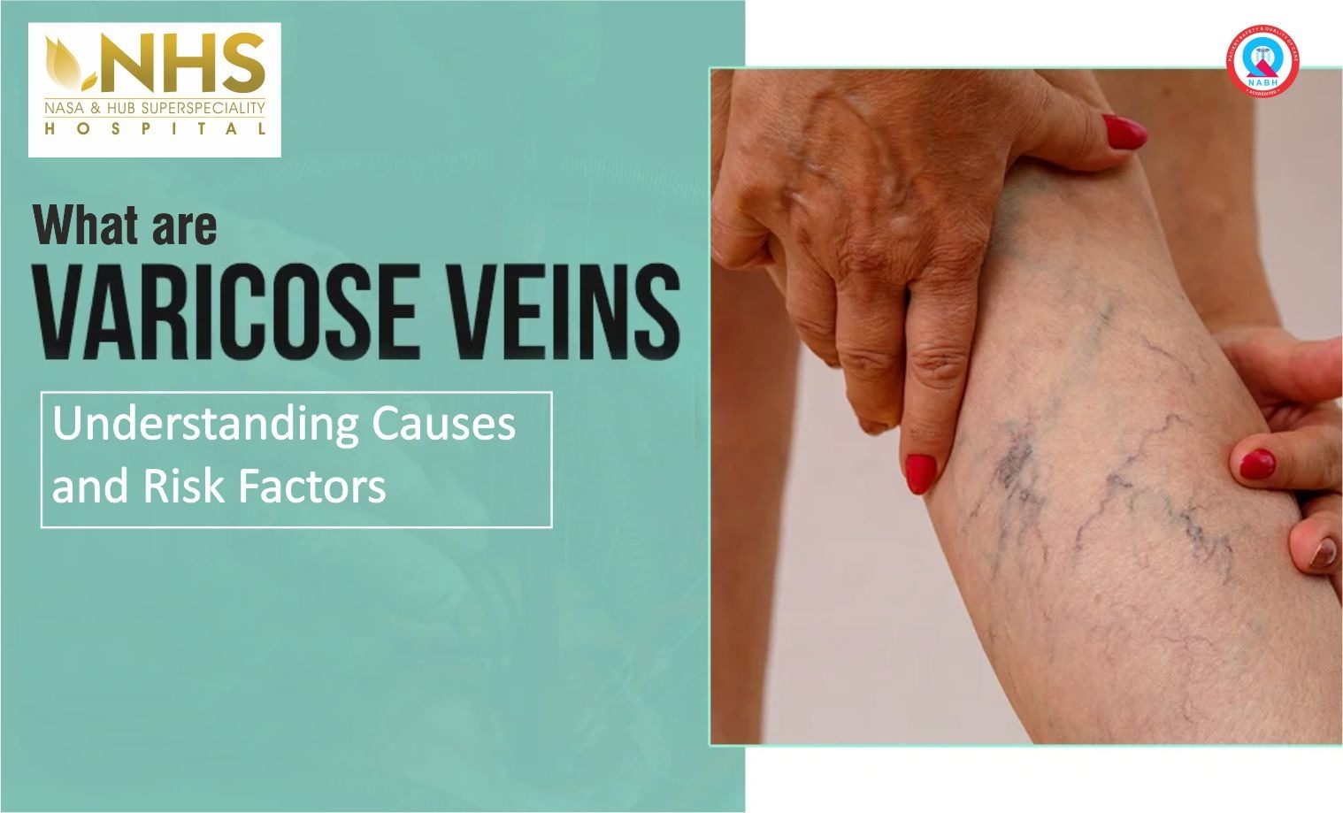 What Are Varicose Veins? Causes, Symptoms & Treatment